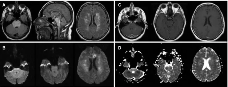 Figure 1. Initial brain magnetic resonance imaging revealed area of swelling and high signal on the brainstem (mainly in pons  and medulla oblongata) and cerebral white-matter abnormalities, which are compatible with the brainstem variant of posterior  rev