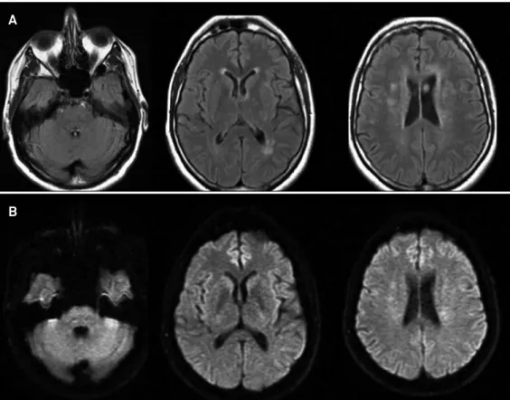 Figure 2. After 6 months of the hypertension management, follow-up brain magnetic resonance imaging showed regression of  vasogenic edema that was graded as complete in brainstem (A, FLAIR-weighted images; B, diffusion-weighted images).