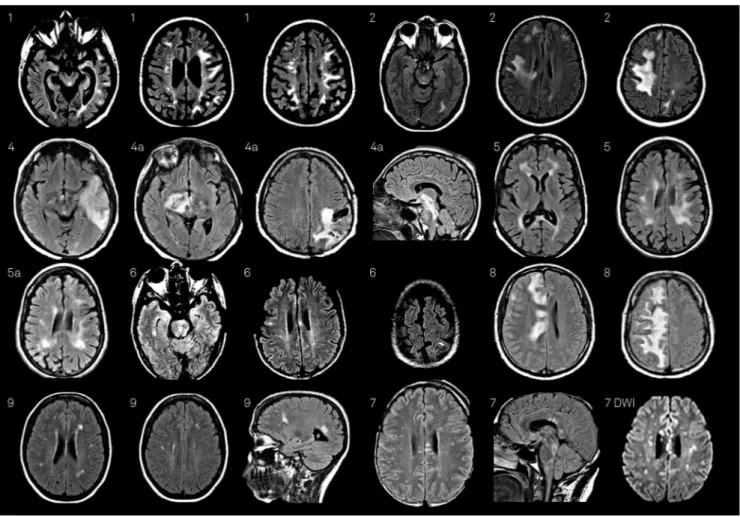 Figure 1. Brain MRI from patients described on Table 1.