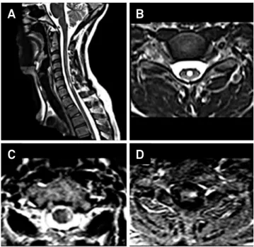 Figure 3. Spinal cord images from patients 3 (top) and 6 (bottom).