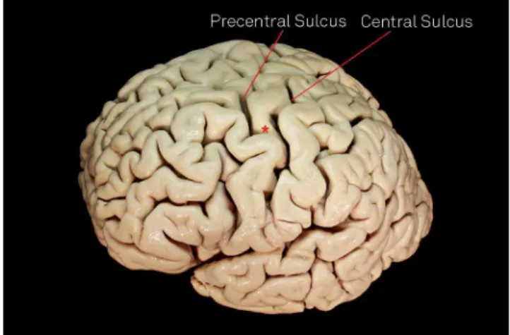 Figure 2. Note a supericial ramus of the precentral sulcus  achieving the central sulcus.