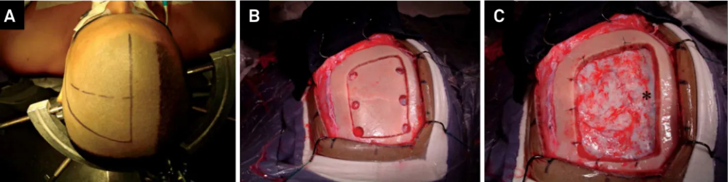 Figure 5. Magnetic resonance image on T1W in axial (A), sagittal (B), coronal (C) and FLAIR (D) shows a non-enhancing lesion  centered at the junction between frontal superior gyrus and the precentral gyrus.
