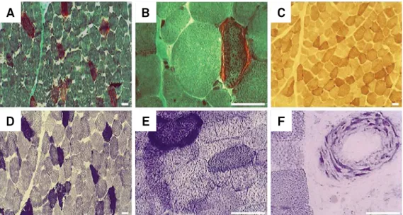 Figure 3. Classic features in the muscle biopsy of MELAS: ragged-red fibers (RRF) on modified Gomori trichrome stain (A, B); 