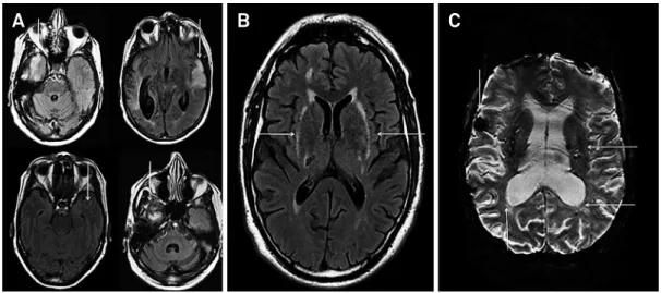 Figure 2. MRI indings. Temporal pole (A) and external capsule involvement (B). Microbleeds (C).