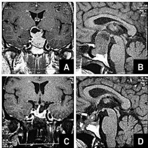 Figure 1. Coronal enhanced and sagittal non-enhanced  preoperative magnetic resonance image (MRI) of a  non-functioning pituitary macroadenomas case (A and B)
