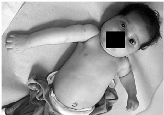 Figure 2. Patient with a total brachial plexus lesion on the  right side showing a lail arm and Horner sign, which is  characterized by miosis, partial ptosis, and enophtalmos