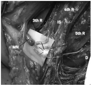 Figure 4. Surgical view of intercostals nerves transfer  to musculocutaneous nerve in the right thoracic region