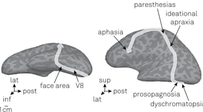 Figure 2. Postulated track of CSD in a patient, following initial  visual symptoms (dyschromatopsia) and culminating in  aphasia 18 