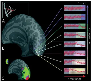 Figure 3. (A) Progression of scintillations and scotoma in left  visual ield of a patient with migraine aura