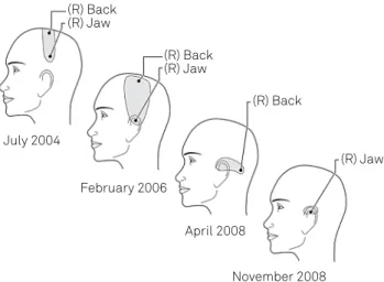 Figure 7. Changes in the optimal coil positions for K.B. over a  4-yr period. Eventually only the pain in her right jaw responded  to tTMS, and this effect was lost 6 months later (July 2009)