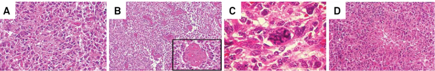 Figure 1. Representative histological sections showing diagnostic features of glioblastoma (hematoxylin and eosin staining).