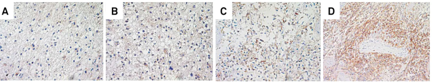 Figure 2. Immunostaining for epidermal growth factor receptor (EGFR) in glioblastoma.
