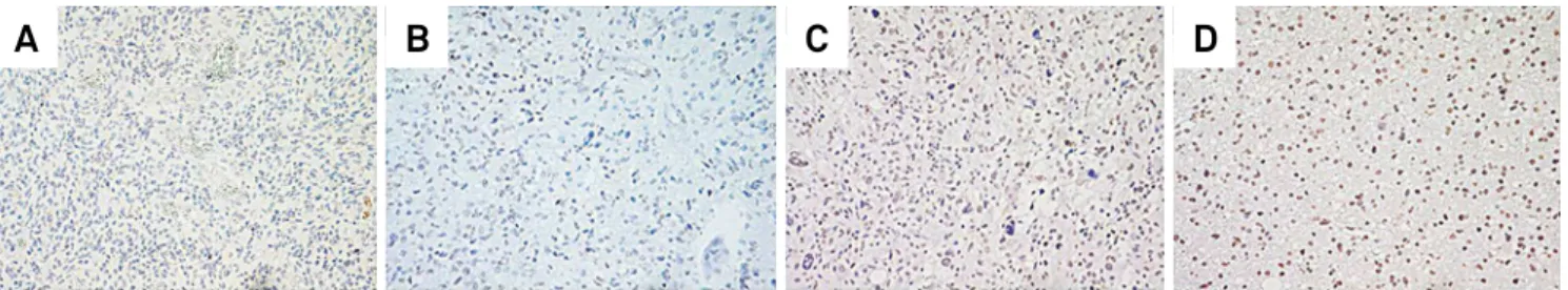 Figure 4. Immunostaining for the mutated form of isocitrate  dehydrogenase-1 (IDH-1) in low-grade diffuse astrocytoma  and glioblastoma.