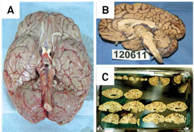 Figure 1. Case 3 (MSA patient) - Basal view of the brain after  removal (A) and sagital section after four weeks in formalin  10%, showing severe atrophy of brainstem and cerebellum (B); 