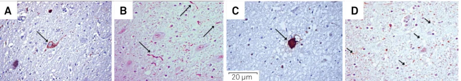 Figure 4. Cases 5 and 10 - pretangles in the medulla oblongata (A); dystrophic neurites in the midbrain (B); tangle in the pons (C)  and granules in the pons (C) (Tau, 400X).