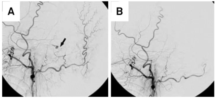 Figure 2. External carotid artery angiogram before (left) and  after (right) embolization