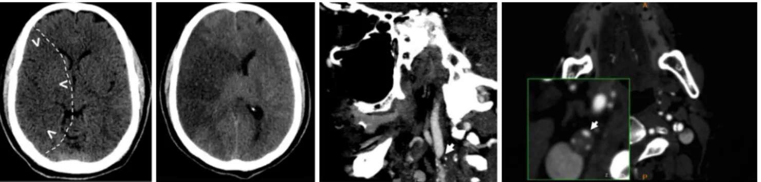 Figure 1. A 56-year-old man presented within 60 minutes of a left hemiplegia. (A) Initial non-contrast CT with subtle 