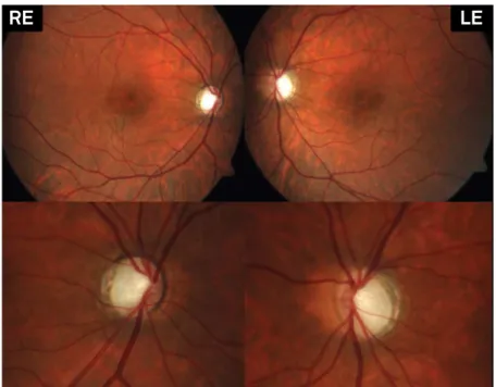 Figure 1. Fundus image discloses marked bilateral atrophic optic discs with temporal pallor.