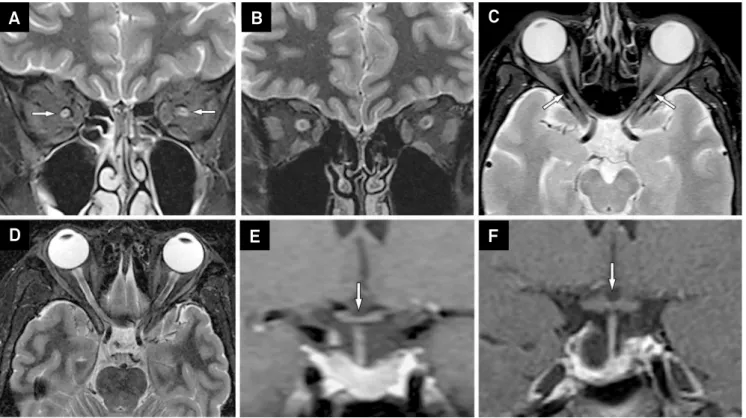 Figure 3. Optic coherence tomography measure around the disc showing thin retina, mainly thin nerve fiber layer performed at two  dates (Nov 05th 2012 and May 21st 2014)