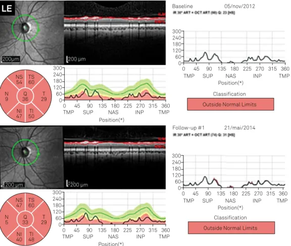 Figure 3. (Continuação) Optic coherence tomography measure around the disc showing thin retina, mainly thin nerve iber layer performed  at two dates (Nov 05th 2012 and May 21st 2014)