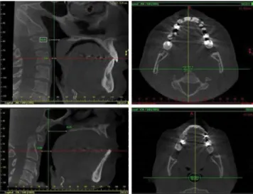 Figure 2. Upper airway Cone Beam Tomography. The 