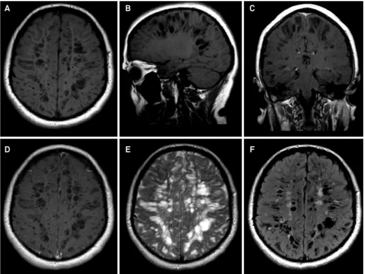 Figure 2. Brain MRI disclosing marked enlarged Virchow-Robin spaces in axial (A) and sagittal (B) unenhanced T1-weighted  images and in coronal (C) and axial (D) enhanced T1-weighted images