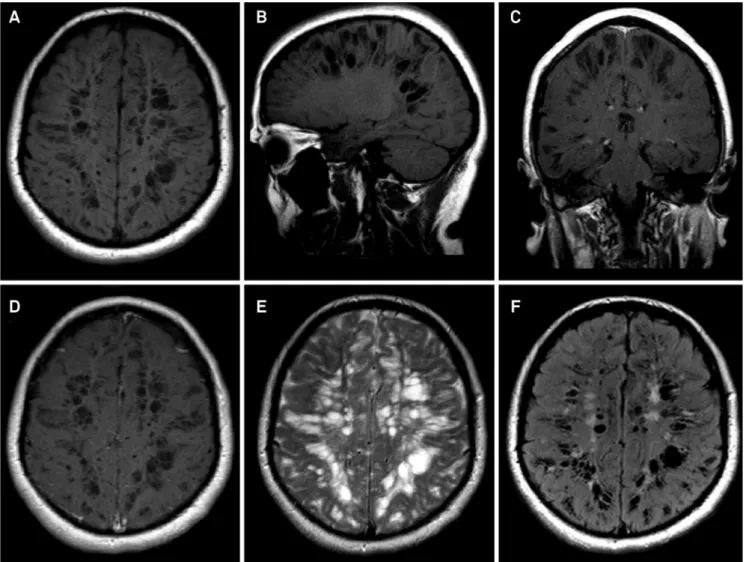 Figure 2. Brain MRI disclosing marked enlarged Virchow-Robin spaces in axial (A) and sagittal (B) unenhanced T1-weighted  images and in coronal (C) and axial (D) enhanced T1-weighted images