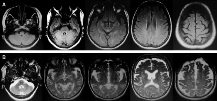 Figure 5. Neuroimaging features described during early (A) and advanced (B) stages of C9orf72-related spectrum disorders