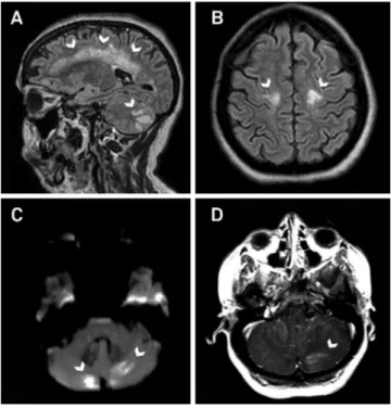 Figure 1. (A) FLAIR images demonstrated signal hyperintensity in the supra- and infratentorial white matter, (B) which was restricted to the corticospinal tracts in the subcortical  pre-central gyri