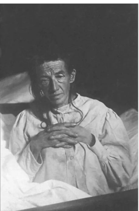 Figure 1. Alois Alzheimer. Figure 2. Auguste Deter.