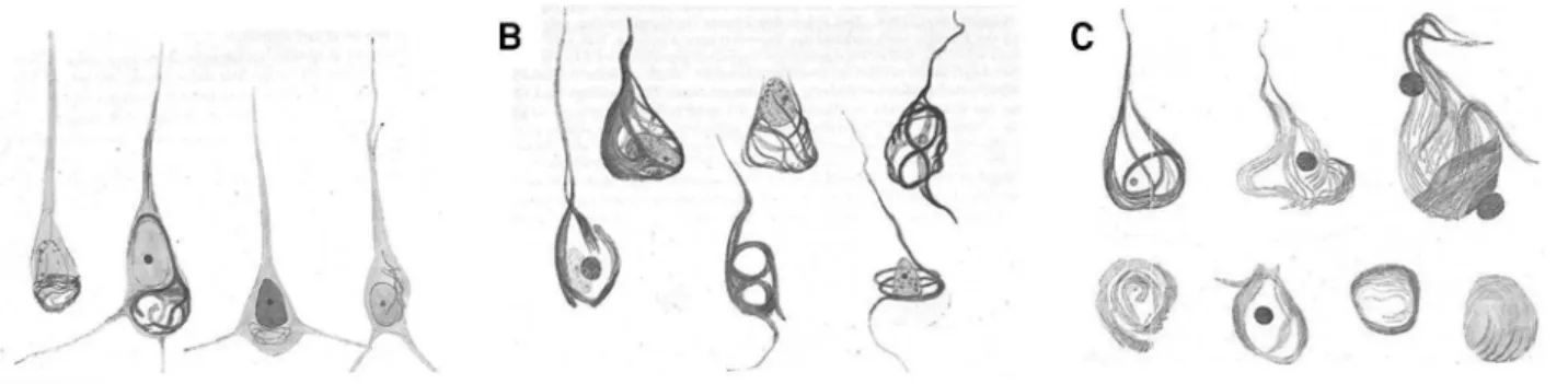 Figure 3. Drawings of histological preparations of Auguste D’s material, stained by Bielschowsky’s technique to demonstrate tangles, and their stages, from Alzheimer’s 1911 paper 9 : (A) Beginning of the disease; (B) Advanced stage; and (C) Terminal state 