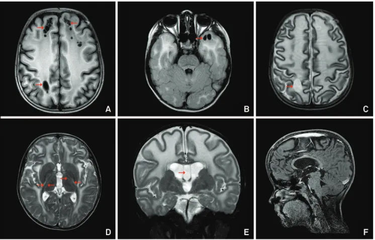 Figure 1. (A), Axial T1-weighted image shows diffuse cerebral white-matter abnormalities with frontoparietal subcortical cysts (arrows)