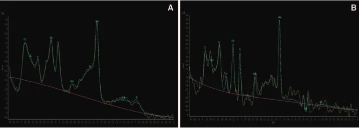 Figure 2. Short TE (31ms) proton-spectroscopy in a control (A) and in the patient with MLC (B) demonstrates mild increased concentration of choline (Cho, in 3.24 ppm) and myoinositol (mI in 3.56 ppm), there is also mild decreased NAA (this pattern is compa