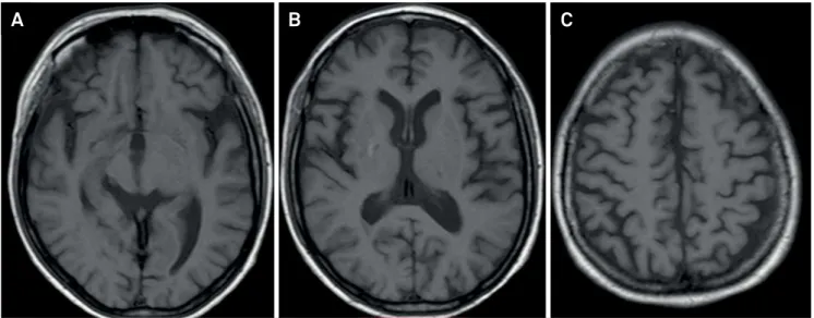 Figure 1. Cortical atrophy in SLE. A 32-year-old female with SLE had a prior stroke due to SLE vasculitis