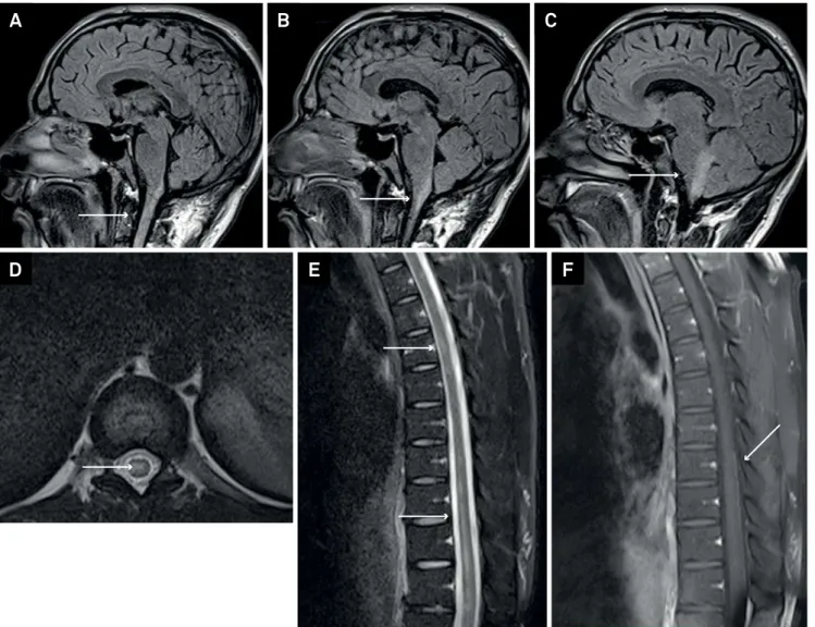 Figure 3. Myelitis in SLE. (A, B, C)  Brain MRI luid-attenuated inversion recovery sequence