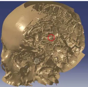 Figure 1. Image from InVesalius Software, highlighting the aneurysm.  