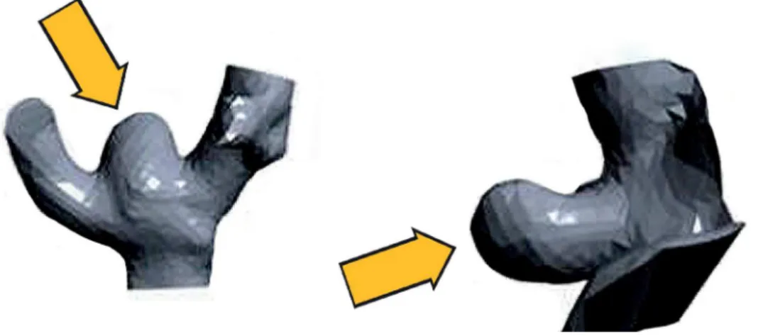 Figure 4. Isolated aneurysms in patients #1 and #2, respectively, in stereolithographic shape (arrows)