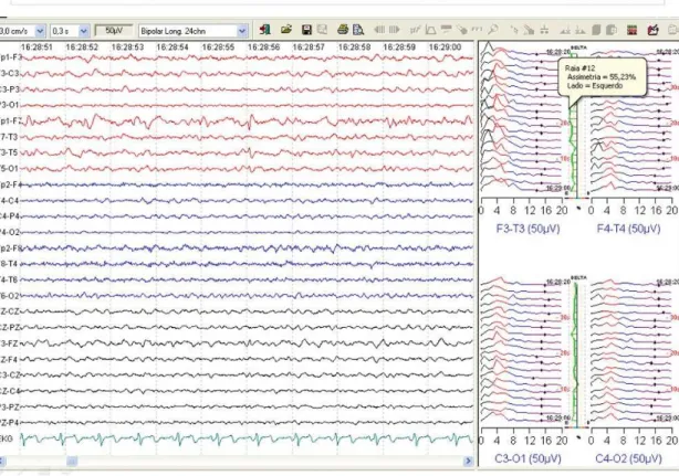 Figure 1. Clinical example showing simultaneous classical electroencephalogram (EEG) channels on the left and Compressed  Spectral Array (CSA) analysis on the right