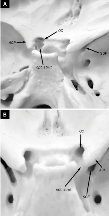 Figure 1.  Bone anatomy of the anterior clinoid process region.