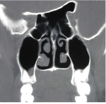 Figure 3. Head CT scan. Preoperative coronal images showing  a pneumatized optic strut and ACP.