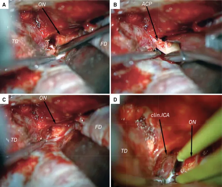 Figure 4. Dolenc approach (left side) for an ophthalmic segment ICA aneurysm. (A) Optic nerve decompression and drilling of the base  of the ACP