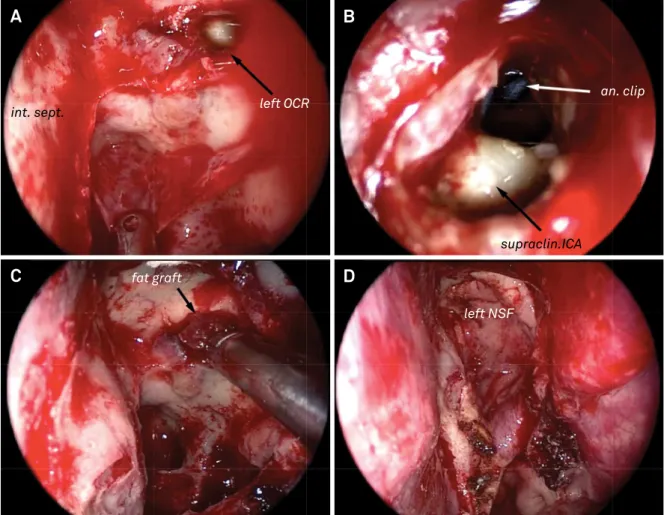 Figure 6. Head computed tomography scan. Postoperative  axial images showing the increased pneumocephalus and  the aneurysm clips