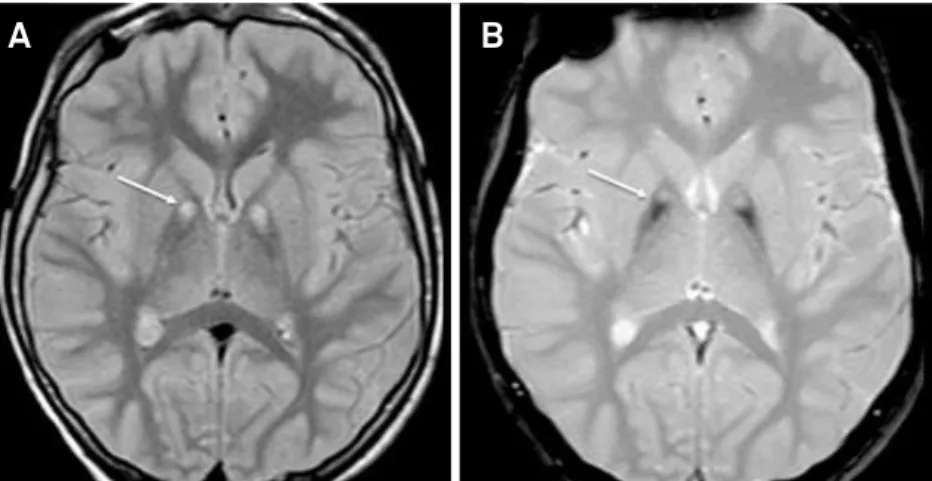 Figure 1. Brain MRI of a patient with pantothenase kinase-associated neurodegeneration (PKAN)