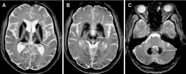 Figure 3. Brain MRI of a patient with aceruloplasminemia MRI discloses global and severe iron accumulation in caudate, pallidus,  thalamus, putamen (A), red nuclei, substantial nigra (B) and dentate nuclei (C)