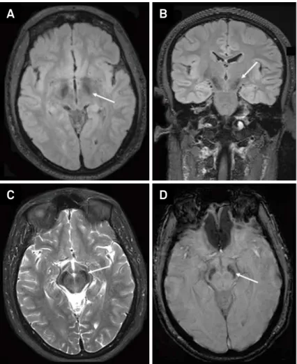 Figure 4. Brain MRI of a patient with beta-propeller protein-associated neurodegeneration (BPAN) or SENDA