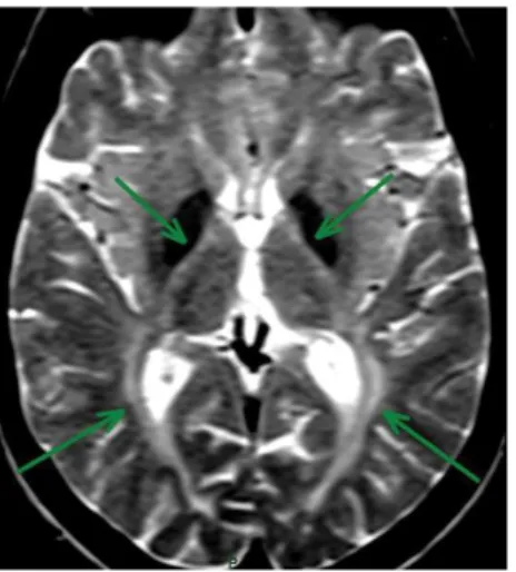 Figure 5. Patient with fatty acid hydroxylase-associated  neurodegeneration (FAHN). Brain MRI shows bilateral globus  pallidus hypointense signal, characterizing iron accumulation,  and conluent periventricular white matter hyperintense signal