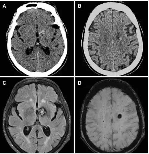 Figure 5. A CT scan image showing left basal ganglia calciication (A); Another left subcortical frontal calciication in the same  patient (B); MRI FLAIR axial depicting typical cavernoma imaging at the left basal ganglia (C); More lesions detected by MR-SW