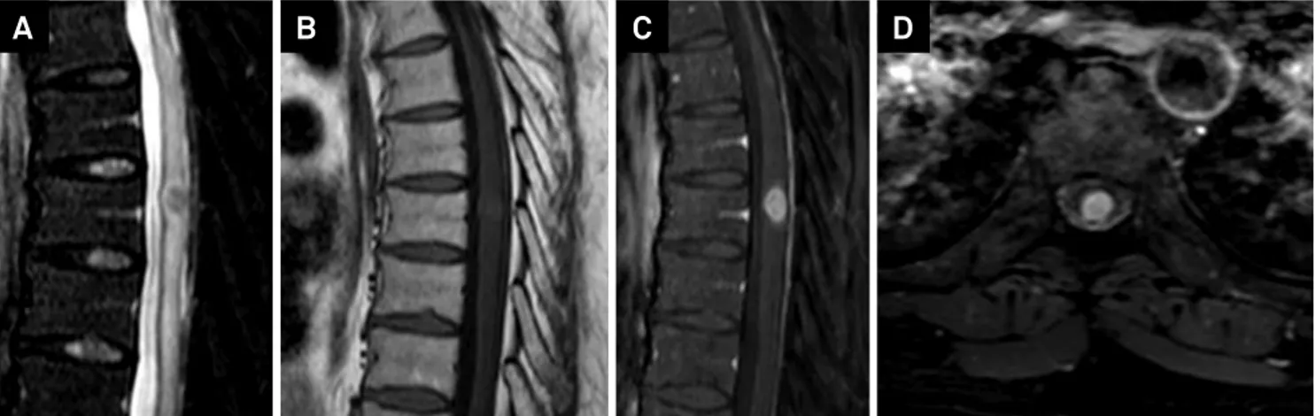Figure 1. Thoracic spine MRI. A) Sagittal T2 weighted image showing a low signal central lesion in the spinal cord at T7 level, with  associated edema above and below
