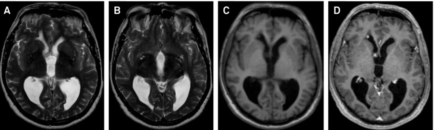 Figure 2. Brain MRI. A and B) axial T2 weighted images demonstrate low signal lesion located at the anterior horn of the right  lateral ventricle (arrow) and another isointense lesion located at the right foramen of Monroe, which suggested the possibility 