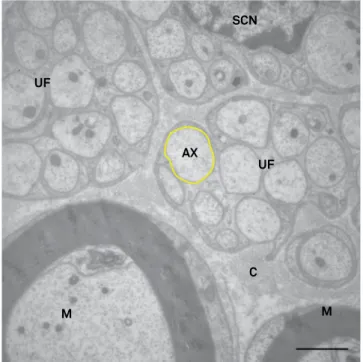 Figure 5. Common ibular nerve histogram showing the  distribution of unmyelinated axon diameters.
